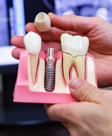 Dental Implants in Ghatkopar