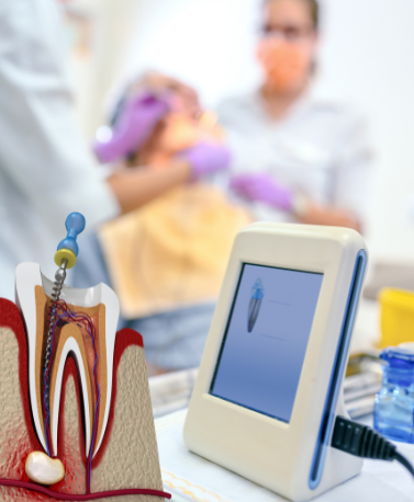 Painless Root Canal Treatment in Ghatkopar