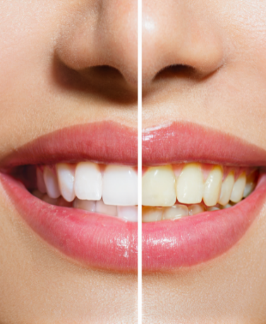 teeth whitening in ghatkopar