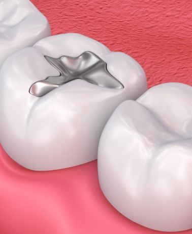 Tooth Filling in Ghatkopar